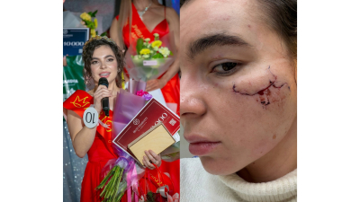 Пять звезд, включая побои: как в Казани изуродовали королеву красоты